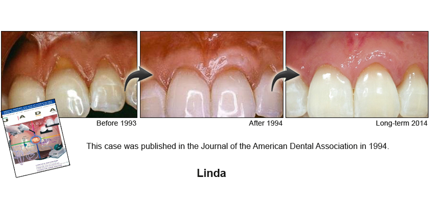 fix gum recession before and after photo