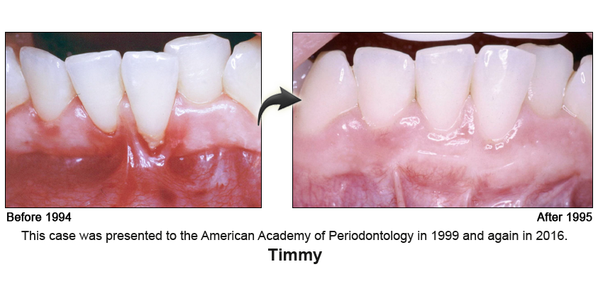 gum treatment before and after photo